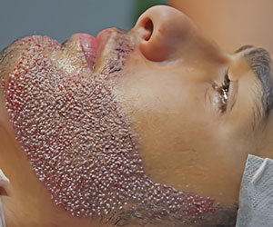 کاشت ریش